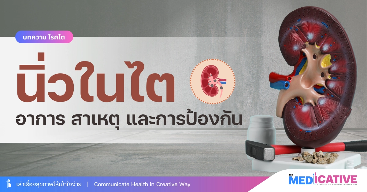 นิ่วในไต อาการ สาเหตุ และการป้องกัน