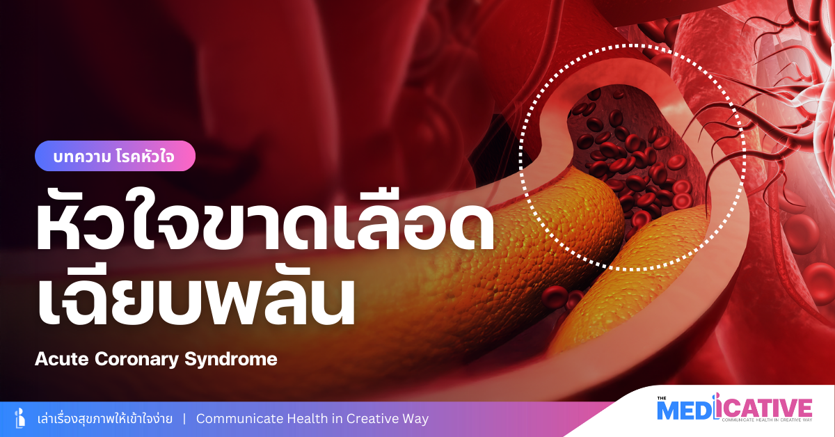 ภาวะหัวใจขาดเลือดเฉียบพลัน